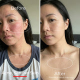 Sf GLow ® 4-in-1 Clinical LED Mask + LED Neck