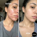 sf GLow ® 4-in-1 Clinical LED Mask + LED Neck