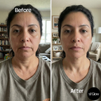 sf GLow ® 4-in-1 Clinical LED Mask + LED Neck