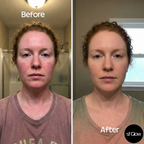 sf GLow ® 4-in-1 Clinical LED Mask + LED Neck