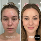 sf GLow ® 4-in-1 Clinical LED Mask