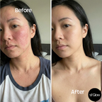 sf GLow ® 4-in-1 Clinical LED Mask + LED Neck