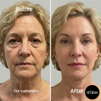 sf GLow ® 4-in-1 Clinical LED Mask