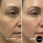 sf GLow ® 4-in-1 Clinical LED Mask