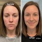 sf GLow ® 4-in-1 Clinical LED Mask