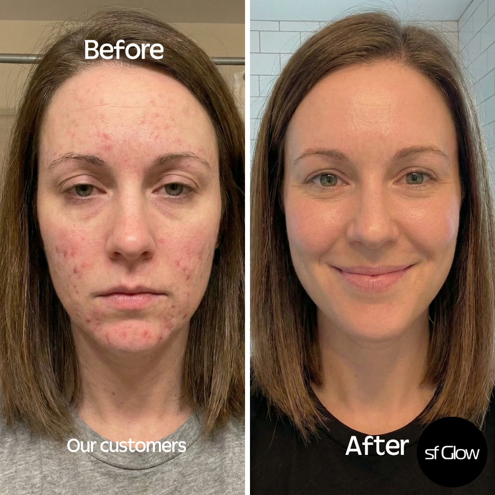 sf GLow ® 4-in-1 Clinical LED Mask