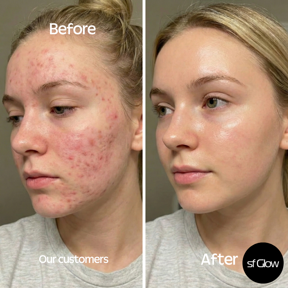 sf GLow ® 4-in-1 Clinical LED Mask