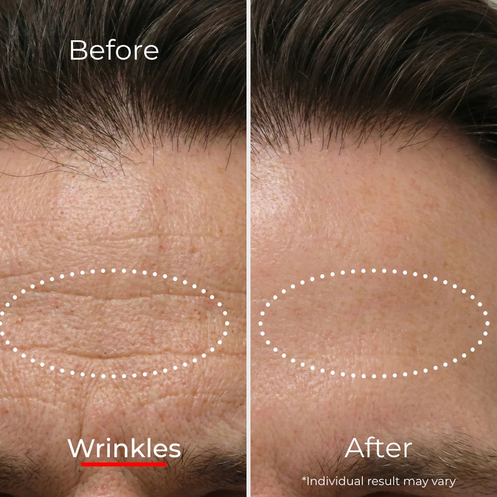 Sf GLow ® 4-in-1 Clinical LED Mask