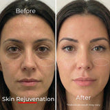 Sf GLow ® 4-in-1 Clinical LED Mask