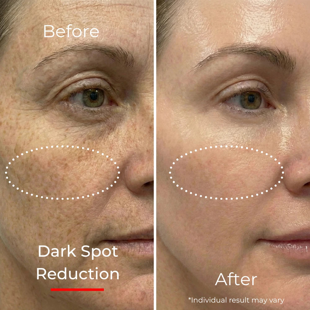 Sf GLow ® 4-in-1 Clinical LED Mask