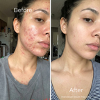 Sf GLow ® 4-in-1 Clinical LED Mask + LED Neck