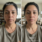 Sf GLow ® 4-in-1 Clinical LED Mask + LED Neck