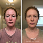 Sf GLow ® 4-in-1 Clinical LED Mask + LED Neck