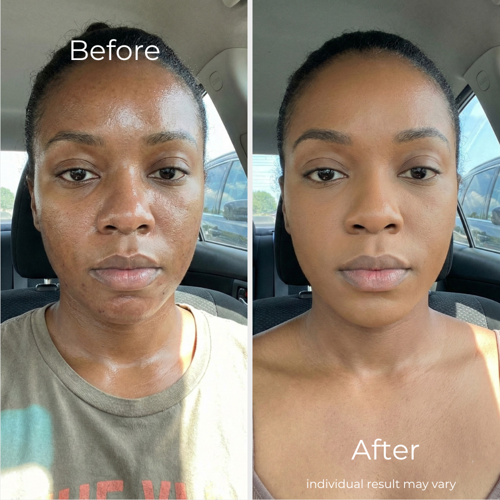 Sf GLow ® 4-in-1 Clinical LED Mask + LED Neck