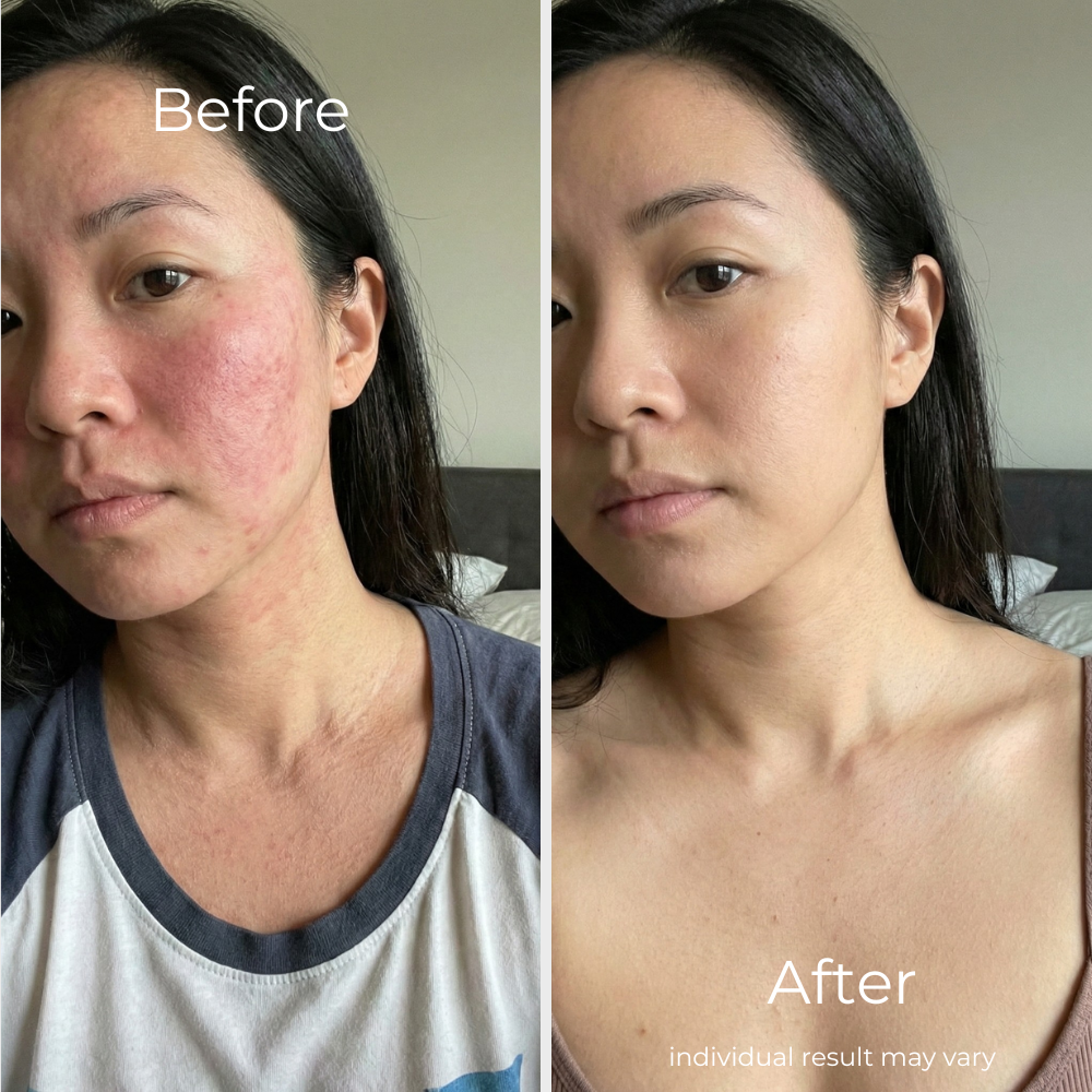 Sf GLow ® 4-in-1 Clinical LED Mask + LED Neck