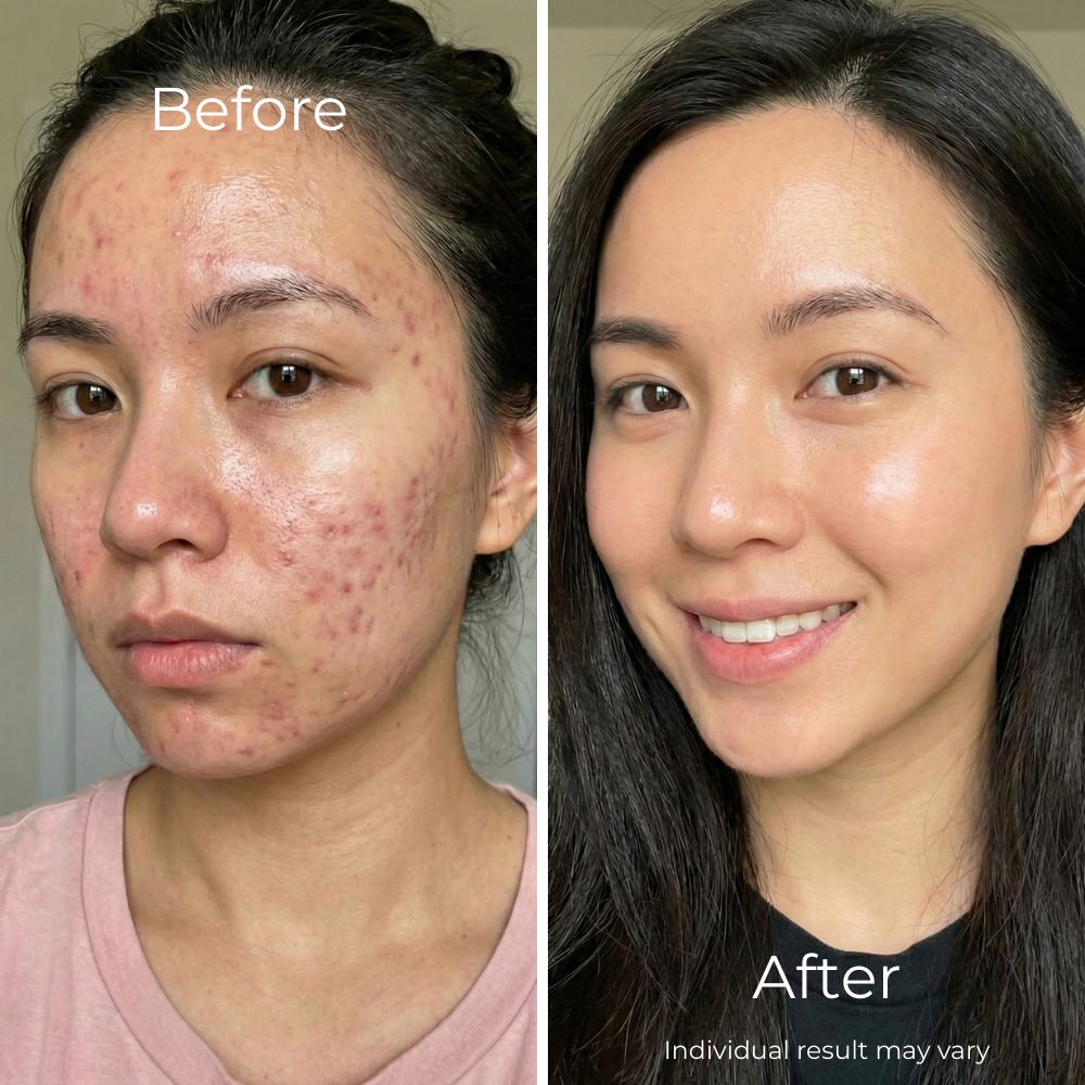 Sf GLow ® 4-in-1 Clinical LED Mask