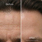 Sf GLow ® 4-in-1 Clinical LED Mask