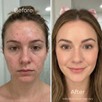 Sf GLow ® 4-in-1 Clinical LED Mask