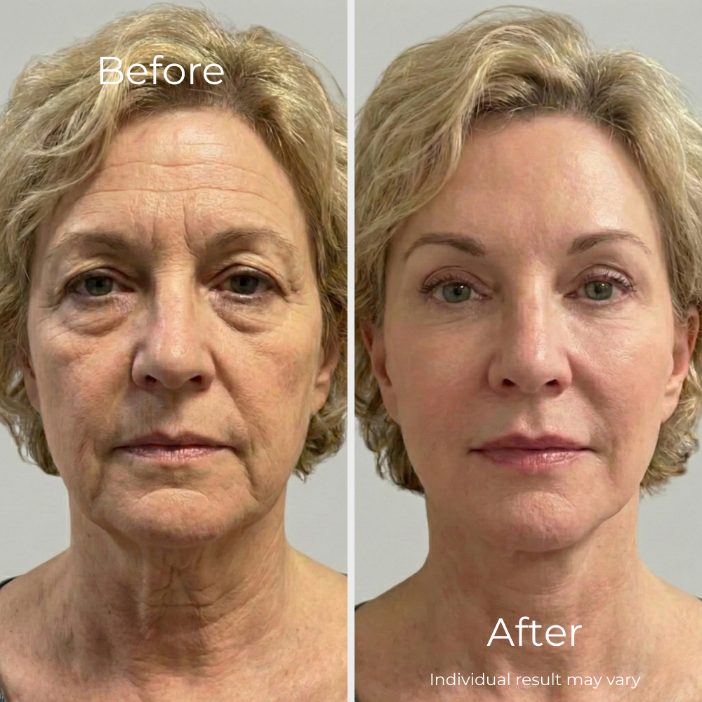 Sf GLow ® 4-in-1 Clinical LED Mask