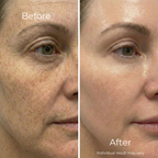 Sf GLow ® 4-in-1 Clinical LED Mask