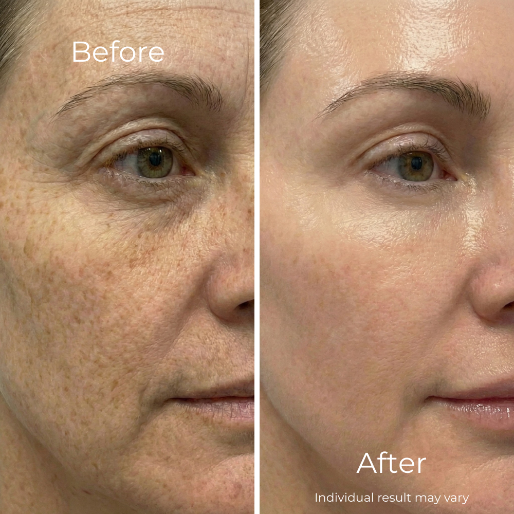 Sf GLow ® 4-in-1 Clinical LED Mask