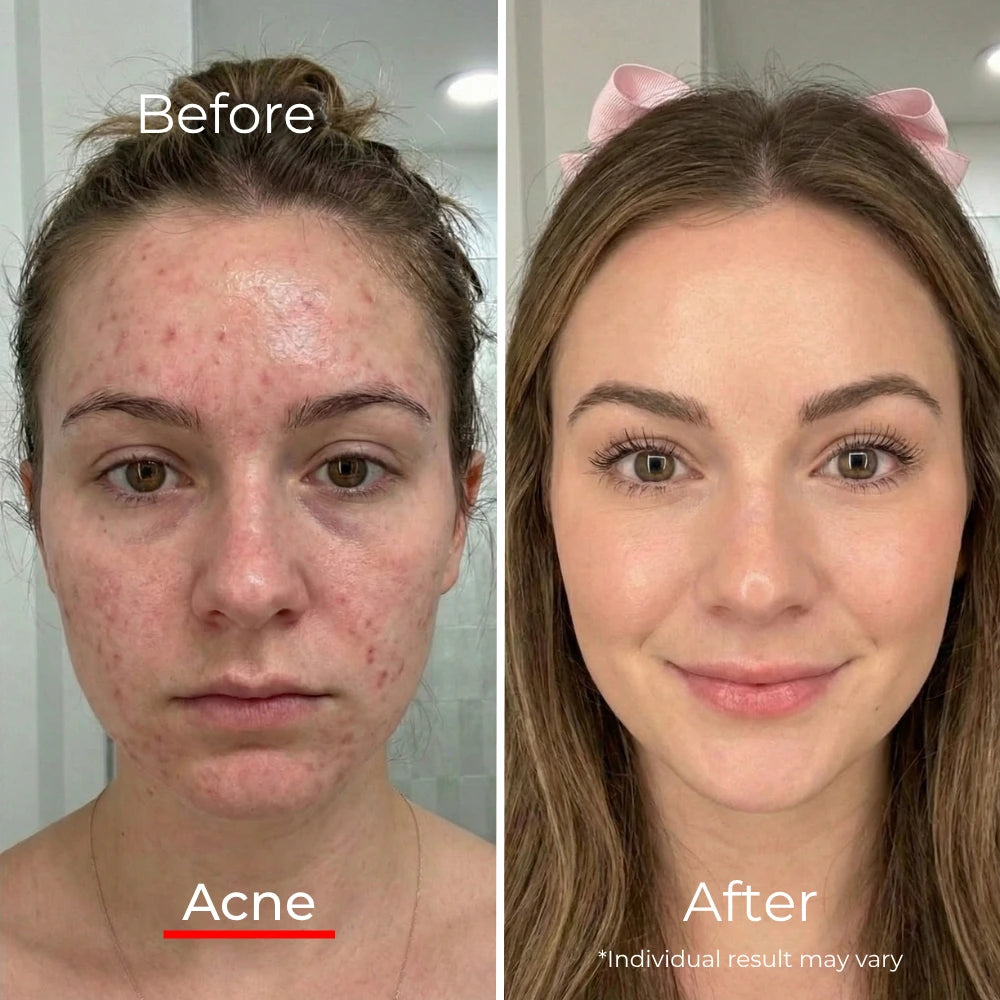 Sf GLow ® 4-in-1 Clinical LED Mask