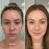 Sf GLow ® 4-in-1 Clinical LED Mask